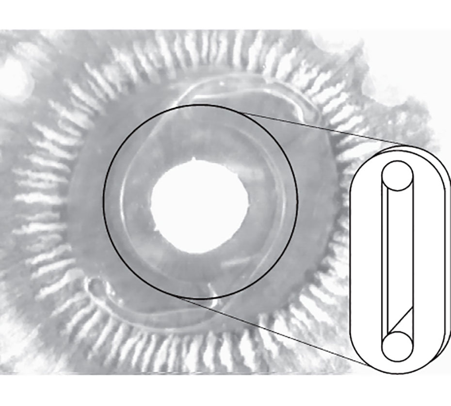Image: Altered mechanical behavior and properties of the human anterior lens capsule after cataract surgery