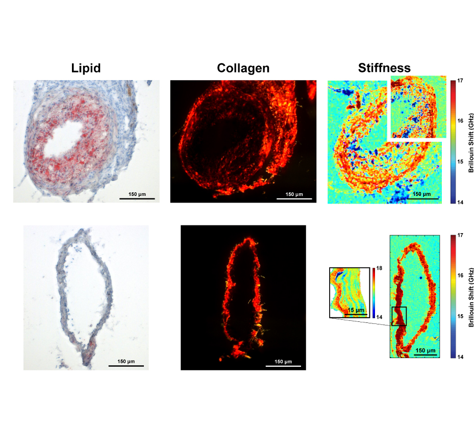 Image: Quantification of plaque stiffness by brillouin microscopy in experimental thin cap fibroatheroma