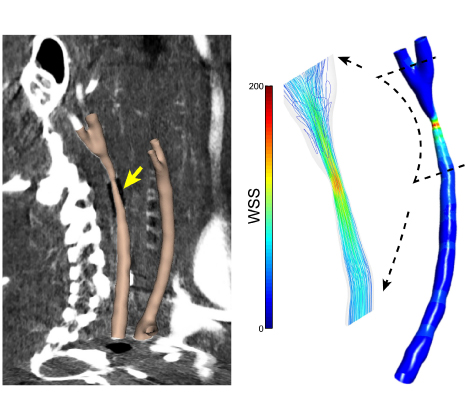 Image: Influence of shear stress magnitude and direction on atherosclerotic plaque composition