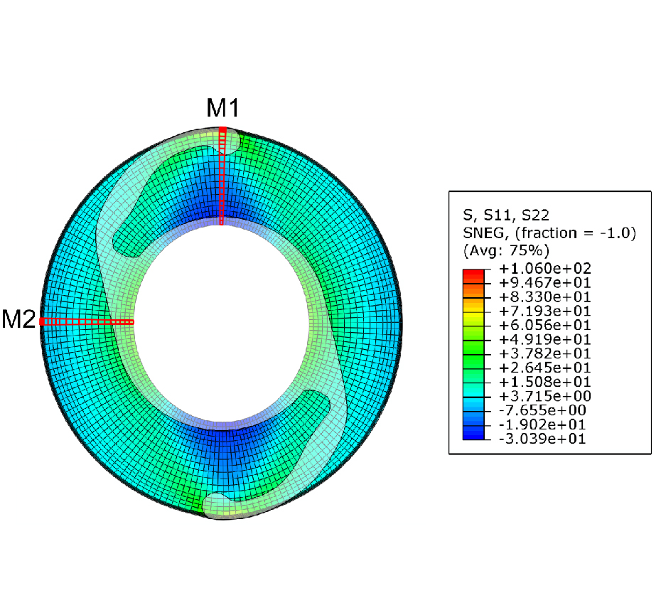 Image: Altered stress field of the human lens capsule after cataract surgery