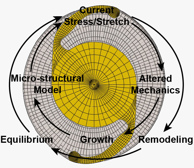 Finite element model of the post-surgical lens capsule with implanted prosthetic intraocular lens (IOL).